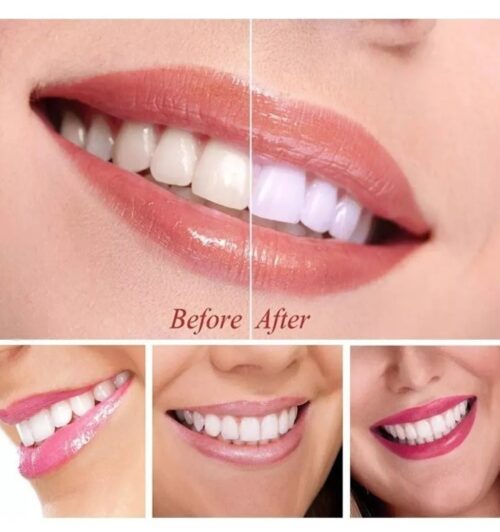 Captura de pantalla 2026-03-13 155239 Blanqueador Dental Gel Tratamiento Whiteline Led Potente En Casa Alta Calidad